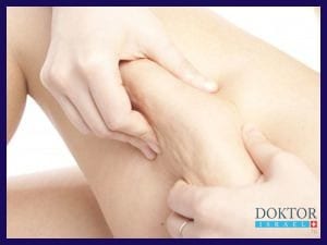 Новое в Бней Цион: лечение целлюлита с помощью озона