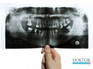 Новая разработка израильтян в области имплантологии