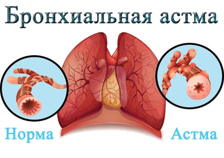 Астма анатомия