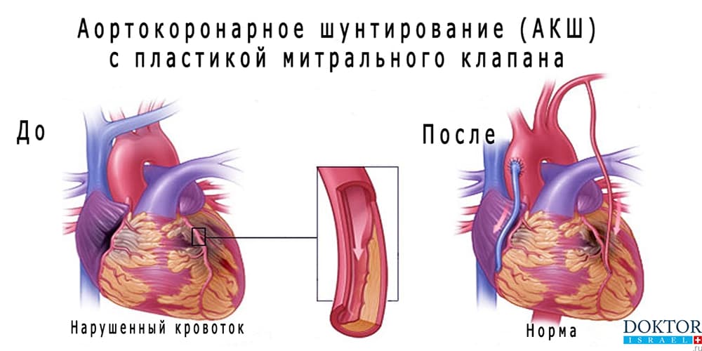 Эффект аортокоронарного шунтирования