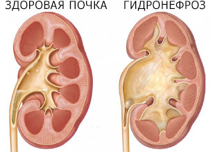 Гидронефроз почки