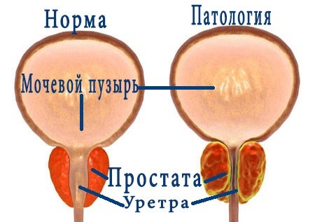 Доброкачественная гиперплазия предстательной железы