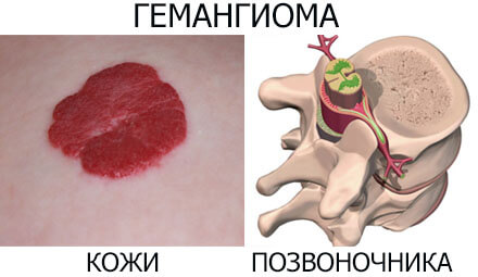 Гемангиома кожи и позвоночника