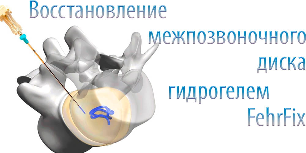 Лечение износа межпозвоночного диска в Израиле