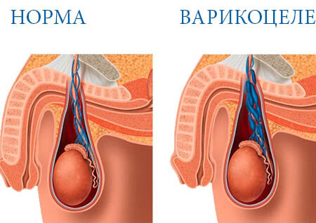 Что представляет собой варикоцеле