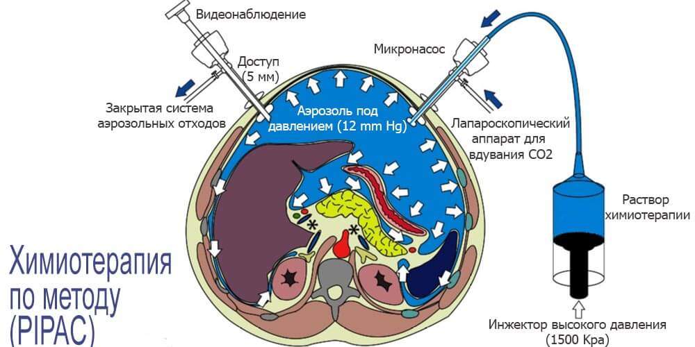 Химиотерапия по методу PIPAC