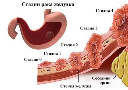 Стадии развития рака желудка