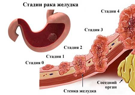 Как лечат рак желудка в израиле thumbnail