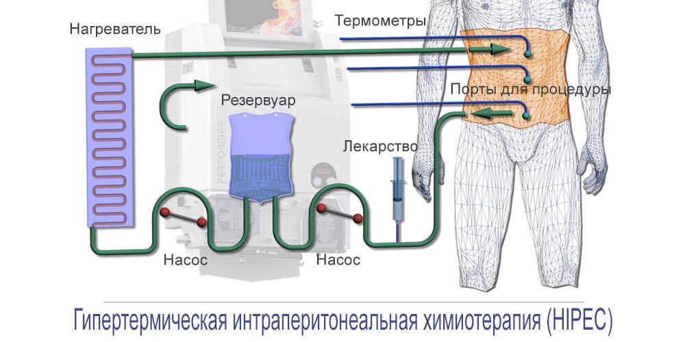 Инновационный метод химиотерапии при лечении рака желудка