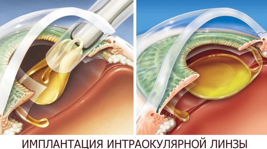 Хирургическое лечение глаз в Израиле