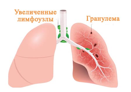 Анатомия саркоидоза