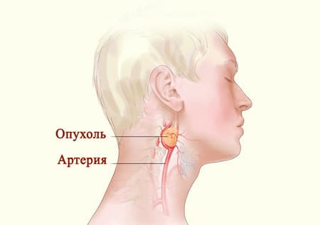 Анатомия хемодектомы