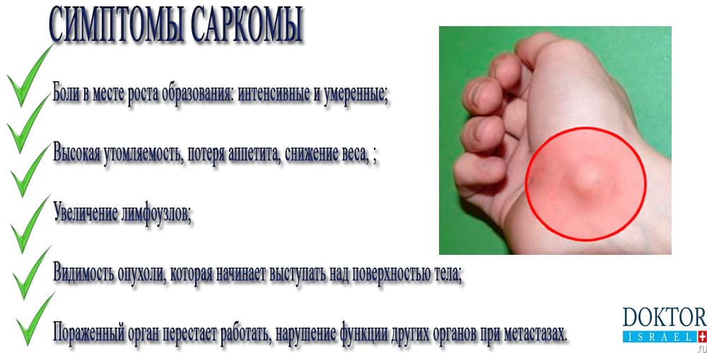 Симптомы саркомы