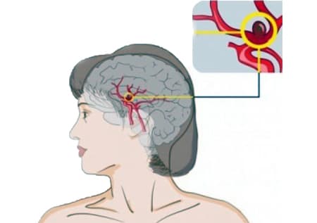 Аневризма головного мозга расположение