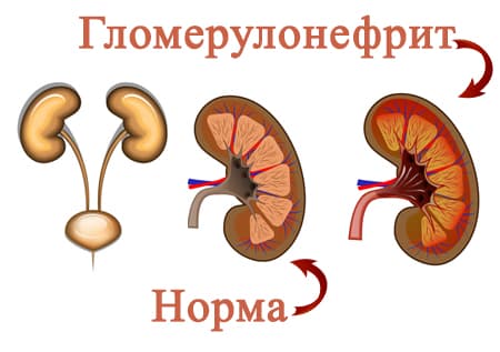 Гломерулонефрит: норма и патология