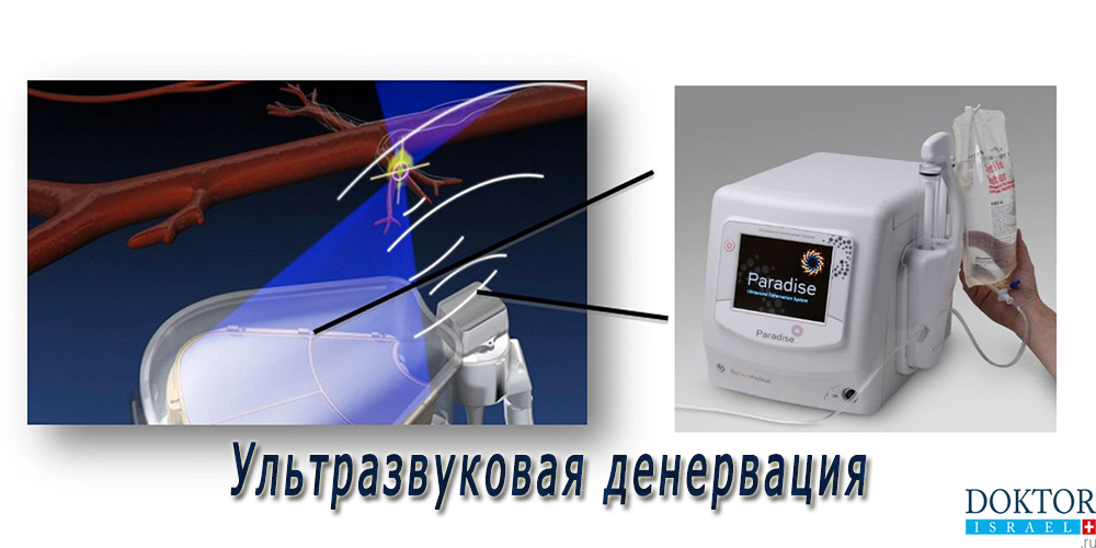 Ультразвуковая денервация