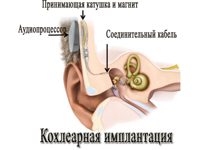 Как вернуть слух