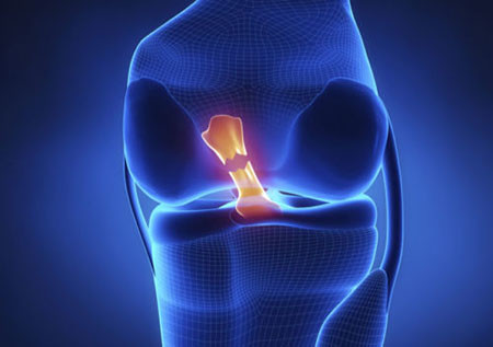 Повреждение связки колена