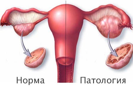 Схематическое изображение яичников в норме и с аномалией