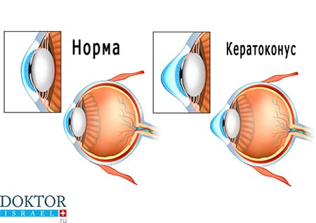 Норма роговицы и кератоконус