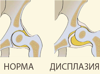 Дисплазия тазобедренного сустава