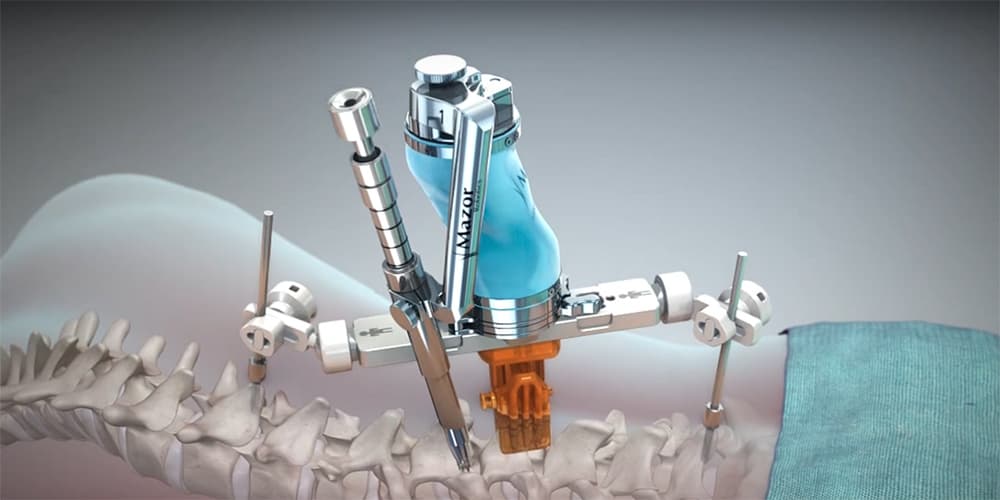 Спинальный робот Spine Assist в Израиле