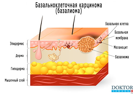 Базалиома проявления