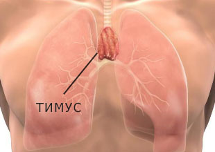 Рак тимуса (вилочковой железы)