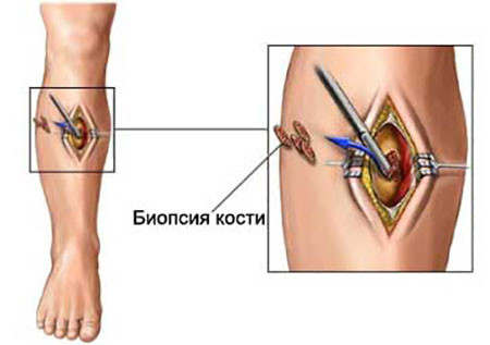 Метод диагностики саркомы Юинга