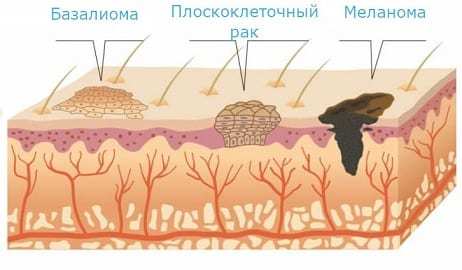 Виды рака кожи