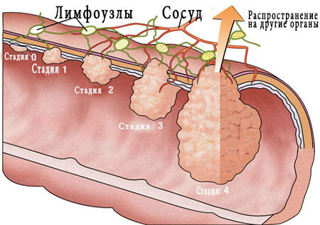 Стадии рака