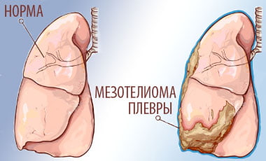 Мезотелиома