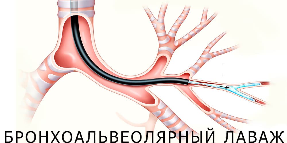 Методы лечения бронхоэктатической болезни в Израиле