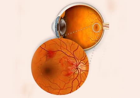 Признаки ретинопатии