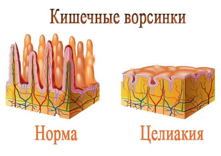 Атрофия кишечника при целиакии