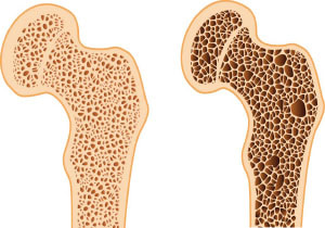 Как выглядит остеопороз