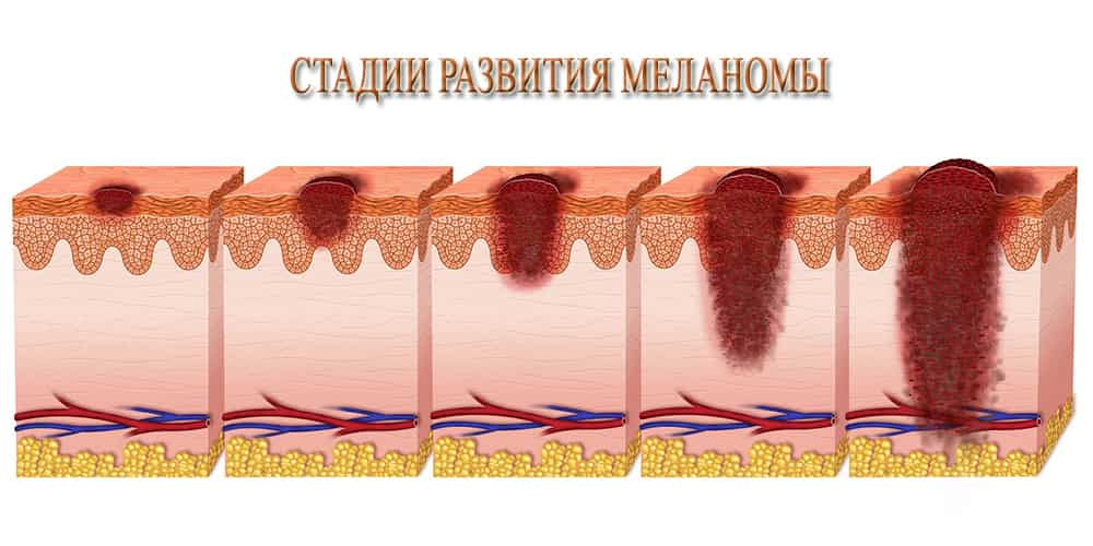 Стадии меланомы