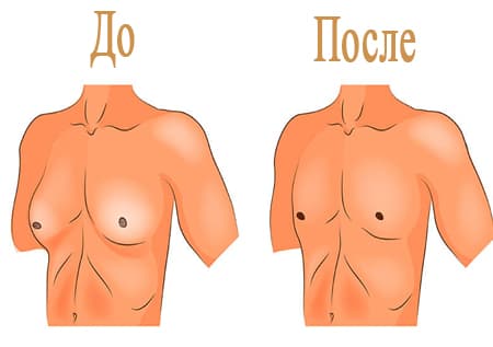 Эффективность операции при гинекомастии