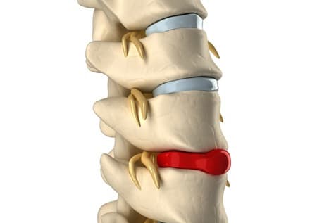 3D изображение грыжи позвоночника